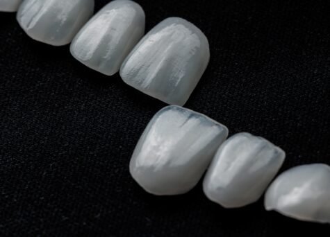 Facettes dentaires: sont-elles faites pour vous?